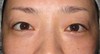 DR.近藤オリジナル　切らない目の下のクマ・たるみ取り（術直後写真）