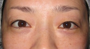 DR.近藤オリジナル　切らない目の下のクマ・たるみ取り（術直後写真）