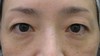 DR.近藤オリジナル　切らない目の下のクマ・たるみ取り（術直後写真）