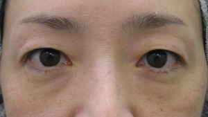 DR.近藤オリジナル　切らない目の下のクマ・たるみ取り（術直後写真）