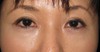 DR近藤オリジナル　切らない目の下のクマ・たるみ取り　（術後2ヶ月写真）