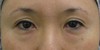 DR近藤オリジナル　切らない目の下のクマ・たるみ取り　（術後2ヶ月写真）