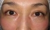 私の目指す美容医療　最小侵襲アンチエイジング外科　MIAS：　DR近藤オリジナル　切らない目の下のクマ・たるみ取り　（術直後写真）