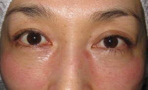 私の目指す美容医療　最小侵襲アンチエイジング外科　MIAS：　DR近藤オリジナル　切らない目の下のクマ・たるみ取り　（術直後写真）