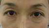 私の目指す美容医療　最小侵襲アンチエイジング外科　MIAS：　DR近藤オリジナル　切らない目の下のクマ・たるみ取り　（術直後写真）