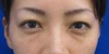 DR近藤オリジナル　切らない目の下のくま・たるみ取り（術直後写真）