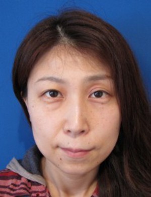 目の下の膨らみと凹みが混在した方に　切らない目の下のクマ・たるみ取り　TCB-R　コンプリート法　＋　法令線・アゴへのラディエッセ注入　（施術直後）