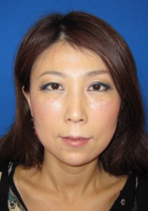 目の下の膨らみと凹みが混在した方に　切らない目の下のクマ・たるみ取り　TCB-R　コンプリート法　＋　法令線・アゴへのラディエッセ注入　（施術直後）