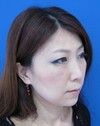 目の下の膨らみと凹みが混在した方に　切らない目の下のクマ・たるみ取り　TCB-R　コンプリート法　＋　法令線・アゴへのラディエッセ注入（施術直後）