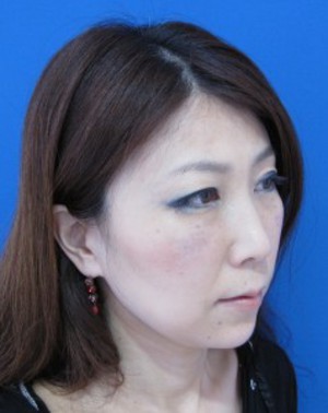 目の下の膨らみと凹みが混在した方に　切らない目の下のクマ・たるみ取り　TCB-R　コンプリート法　＋　法令線・アゴへのラディエッセ注入（施術直後）