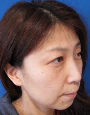 目の下の膨らみと凹みが混在した方に　切らない目の下のクマ・たるみ取り　TCB-R　コンプリート法　＋　法令線・アゴへのラディエッセ注入（施術直後）