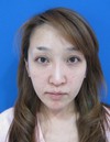 私の目指す美容医療　MIAS：　DR近藤オリジナル切らないお顔の引き上げ術　チタンペックリフト　＋　自分の血液から作るゲル（PPP-GEL）のチークへの注入　
