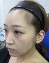 私の目指す美容医療　MIAS：　DR近藤オリジナル切らないお顔の引き上げ術　チタンペックリフト　＋　自分の血液から作るゲル（PPP-GEL）のチークへの注入　