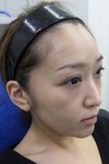 私の目指す美容医療　MIAS：　DR近藤オリジナル切らないお顔の引き上げ術　チタンペックリフト　＋　自分の血液から作るゲル（PPP-GEL）のチークへの注入　