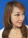 私の目指す美容医療　MIAS：　DR近藤オリジナル切らないお顔の引き上げ術　チタンペックリフト　＋　自分の血液から作るゲル（PPP-GEL）のチークへの注入　