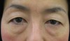 目の上のたるみにお悩みの方に：DR.近藤　眉下切開による 上まぶたのたるみ/脂肪取り