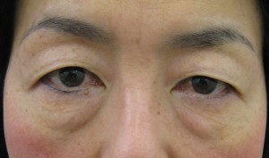 目の上のたるみにお悩みの方に：DR.近藤　眉下切開による 上まぶたのたるみ/脂肪取り