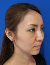 素敵な人がより素敵に！　モデルは当院スタッフ その１　自分の血液から作るPPP-GEL(プラズマジェル)の注入で　活き活きチーク！！　  