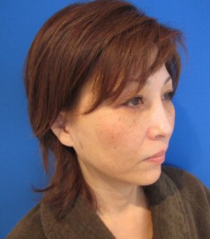 私の目指す美容外科　MIAS：最小侵襲アンチエイジング外科　DR　近藤オリジナル　切らないお顔の引き上げ術　チタンペックリフト®