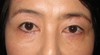 目の上のたるみにお悩みの方に：DR.近藤　眉下切開による 上まぶたのたるみ/脂肪取り