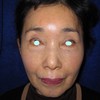 おでこの形・おでこのシワ　とにかくおでこにお悩みの方に　脳神経外科専門医が行う安全・確実なSOグレイス前額リフト