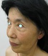 ＊おでこのシワ、形、とにかく　おでこに　お悩の全ての方に：脳外科専門医が行う前額形成リフト