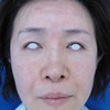 スムースクールによる美白　＆　アンチラックスによる　お顔の引き締め