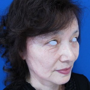 DR近藤オリジナル　切らない目の下のたるみ取り　＆　口角へのラディエッセ注入
