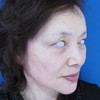 DR近藤オリジナル　切らない目の下のたるみ取り　＆　口角へのラディエッセ注入
