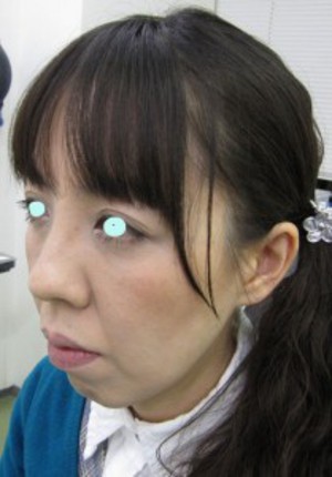 たった数分で　確実に　でも　さりげなく　貴女の美しさを　引き出します：DR　近藤　こだわりのラディエッセ注入　ゴルゴライン・アゴ