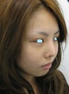 Dr.近藤　こだわりのプチ整形・アゴのラディエッセ注入