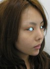 Dr.近藤　こだわりのプチ整形・アゴのラディエッセ注入