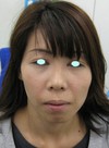 DR近藤　こだわりのプチ整形　あご　（ラディエッセ注入）