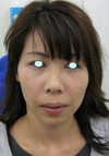 DR近藤　こだわりのプチ整形　あご　（ラディエッセ注入）