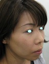 DR近藤　こだわりのプチ整形　あご　（ラディエッセ注入）