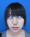 DR.近藤　こだわりのプチ整形　たった数分でこんなに素敵に！　顎のラディエッセ注入