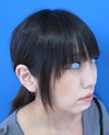 DR　近藤　こだわりのプチ整形　たった数分でこんなに素敵に！　顎のラディエッセ注入