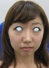 DR近藤　こだわりのプチ整形（アゴ　鼻のラディエッセ注入）