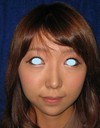 DR近藤　こだわりのプチ整形（アゴ　鼻のラディエッセ注入）