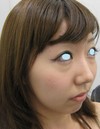 DR近藤　こだわりのプチ整形　（ラディエッセ注入　あご　鼻）