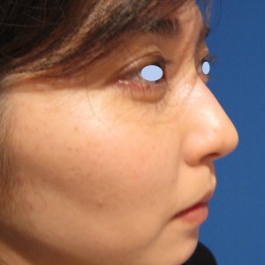 DR.近藤　こだわりのラディエッセ注入　鼻尖