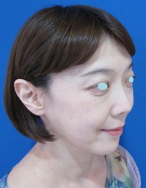 たった数分で　確実に　でも　さりげなく　貴女の美しさを　引き出します：DR　近藤　こだわりのラディエッセ注入　ゴルゴライン・アゴ