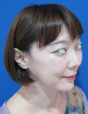 たった数分で　確実に　でも　さりげなく　貴女の美しさを　引き出します：DR　近藤　こだわりのラディエッセ注入　ゴルゴライン・アゴ