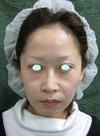 手術でなくても　ほんの数分で　こんなに素敵になれます！　DR 近藤　こだわりのラディエッセ注入・ゴルゴライン、鼻、アゴ