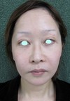 手術でなくても　ほんの数分で　こんなに素敵になれます！　DR 近藤　こだわりのラディエッセ注入・ゴルゴライン、鼻、アゴ