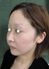 手術でなくても　ほんの数分で　こんなに素敵になれます！　DR 近藤　こだわりのラディエッセ注入・ゴルゴライン、鼻、アゴ