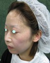 手術でなくても　ほんの数分で　こんなに素敵になれます！　DR 近藤　こだわりのラディエッセ注入・ゴルゴライン、鼻、アゴ