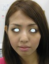 DR.近藤　こだわりのラディエッセ注入　アゴ・鼻