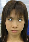 DR.近藤　こだわりのプチ整形　ラディエッセ注入　ゴルゴライン(チーク）・アゴ