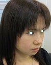 DR.　近藤　こだわりのプチ整形　ラディエッセ注入　ゴルゴライン(チーク）・アゴ